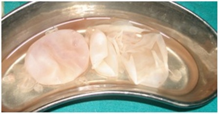 Figure-5: Multiple hydatid cysts
